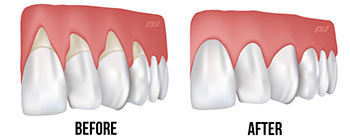 Gum Grafting in Toronto, ON