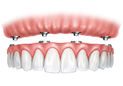 Dental Implants in Toronto, ON