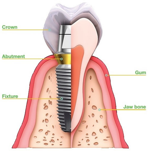 dental implants