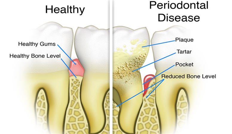 Periodontal Disease