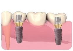 Dental Implants in Toronto, ON