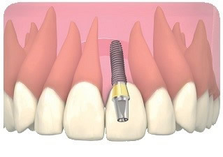Dental Implants in Toronto, ON