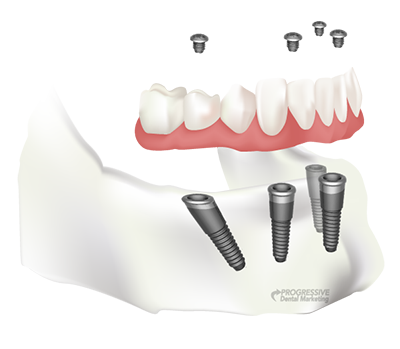 All-on-4 Dental Implants